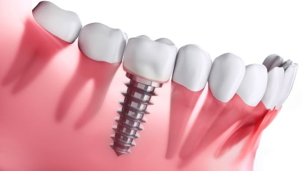 implante dental terminado